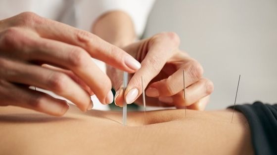 0.16 มิลลิเมตร เงิน Intradermal กลีบเข็มสําหรับบรรเทาความเจ็บปวด